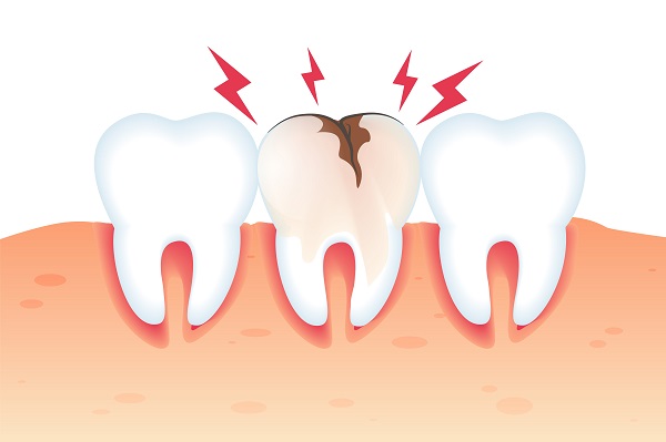 Dor em vários dentes ao mesmo tempo – qual pode ser a causa